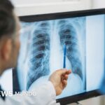 Qué es un adenocarcinoma pulmonar, el tipo de tumor maligno que le extirparon al papa León XIV