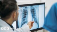 Qué es un adenocarcinoma pulmonar, el tipo de tumor maligno que le extirparon al papa León XIV