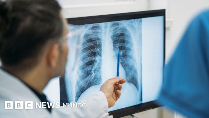 Qué es un adenocarcinoma pulmonar, el tipo de tumor maligno que le extirparon al papa León XIV